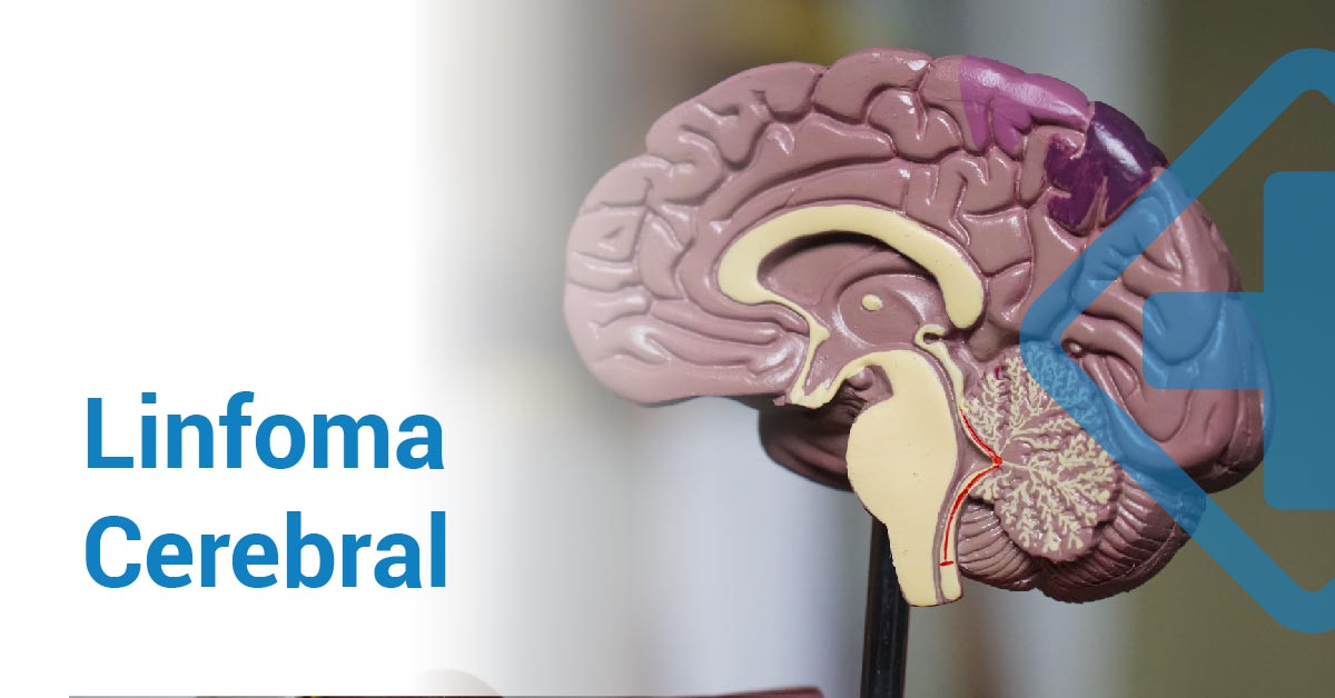 Linfoma cerebral primario